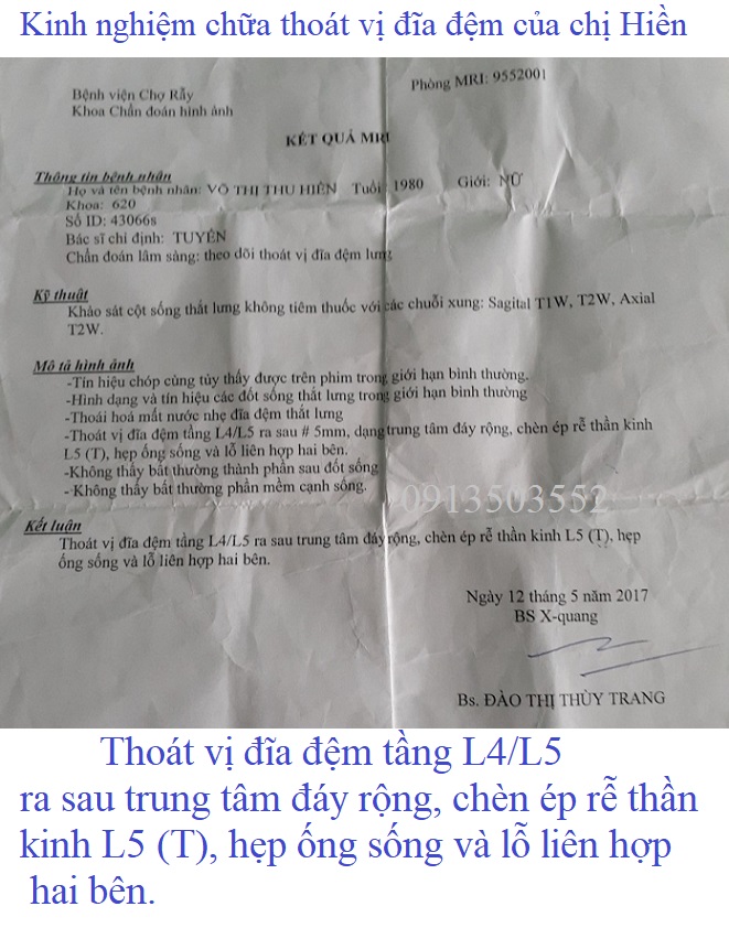 Thoát vị đĩa đệm tầng L4/L5